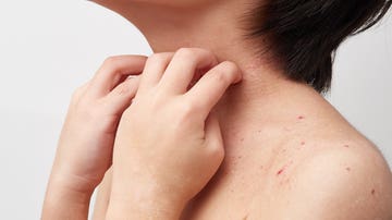 Dermatitis atópica